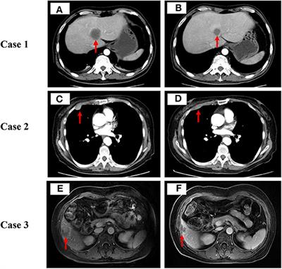 Case Report: Low-Dose Decitabine Plus Anti-PD-1 Inhibitor Camrelizumab for Previously Treated Advanced Metastatic Non-Small Cell Lung Cancer